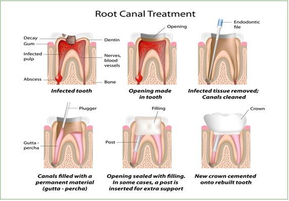 root canal therapy yorba linda
