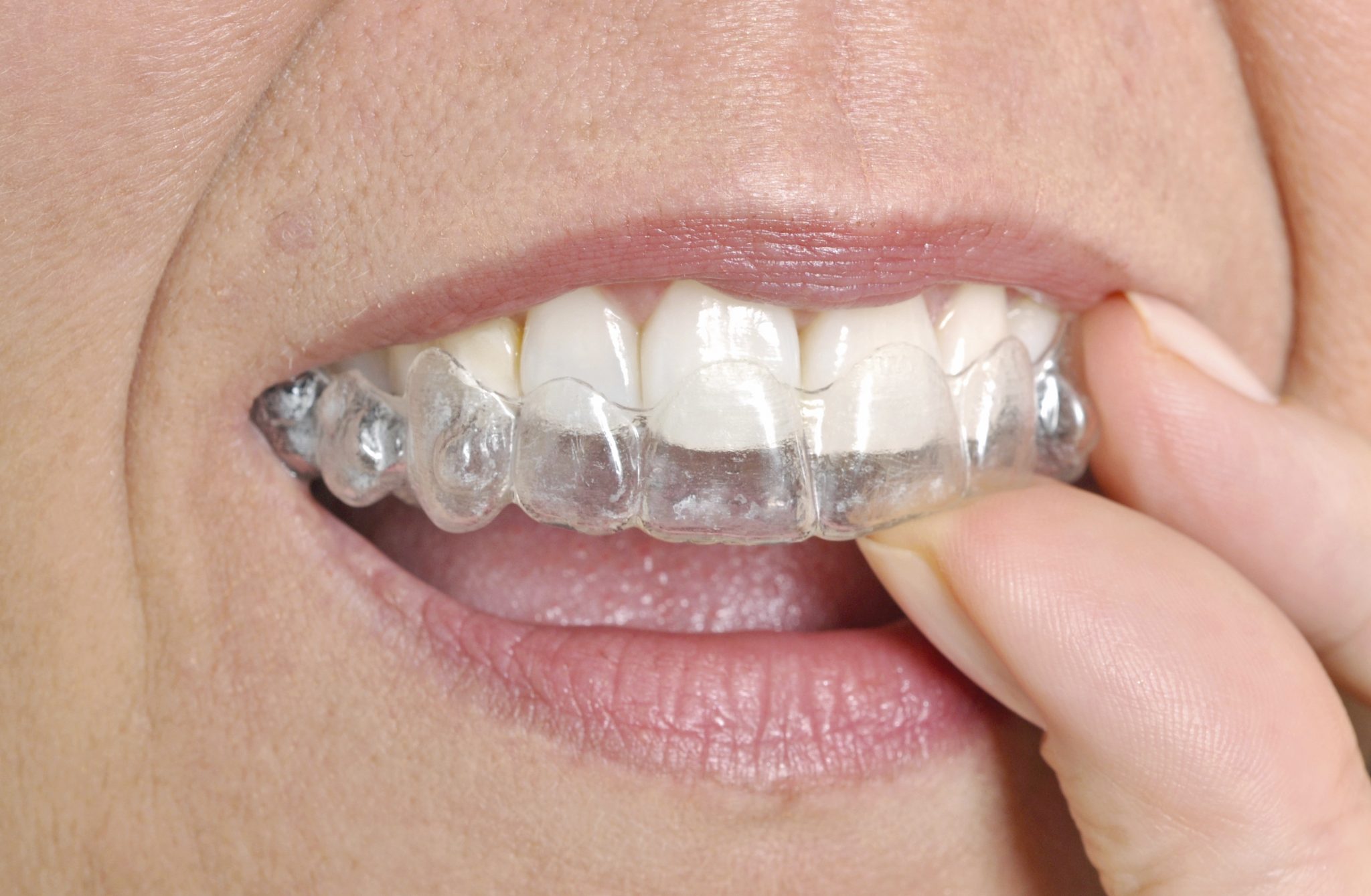Choosing Clear Braces over Traditional Braces East Lake Advancing